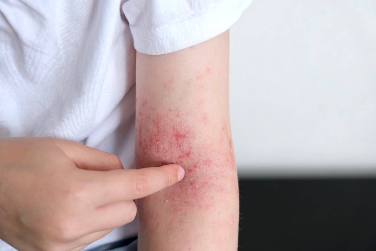 How Red Light Therapy Can Help With Eczema